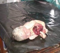 राजपुरमा अनौंठो बच्चाककाे जन्म (फोटो)