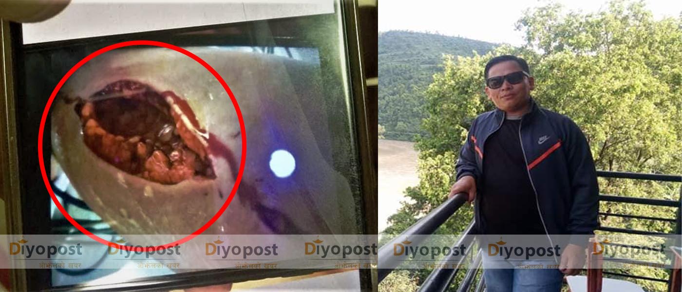 राजधानीमा निलकण्ठ नगरपालिका १४ धुवाँकोटका वडाध्यक्ष फन्द्रा तामाङमाथि खुकुरी प्रहार