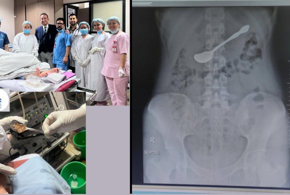 पेटमा अड्किएको चम्चा बिनाशल्यक्रिया निकाल्न सफल