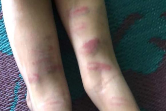 झापामा गृहकार्य नगरेको भन्दै विद्यार्थीमाथि निर्घात कुटपिट