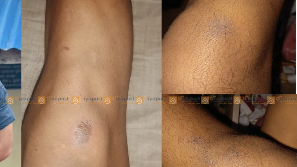 मुग्लिनका प्रहरी निरीक्षक सिंहमाथि नाबालकलाई यातना दिएको आरोप, छानबिनको माग